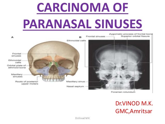 Tumours of the Skull Base and Paranasal Sinuses
